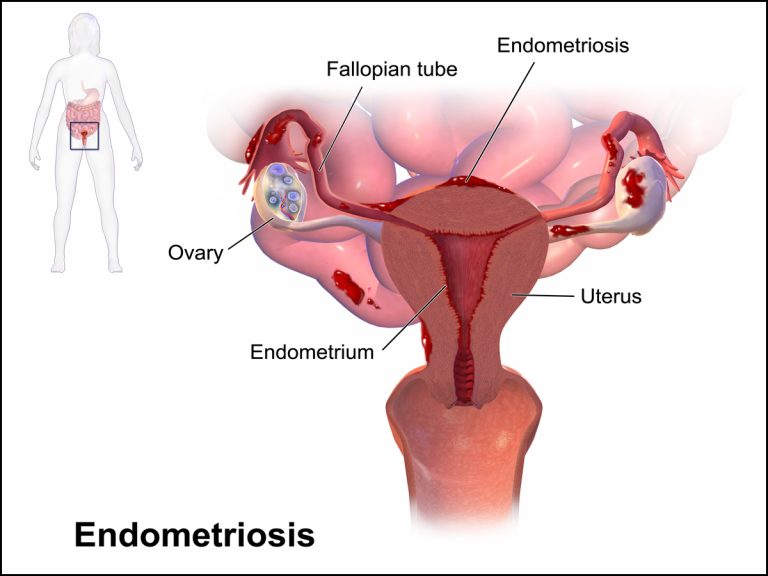 Schematische Darstellung von Endometriose im weiblichen Unterleib